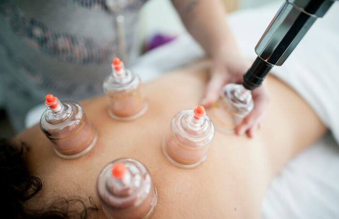 Person receiving cupping therapy on back, illustrating bizarre beliefs people still fall for despite science busting myths.