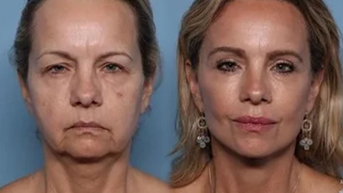 Before and after plastic surgery transformation of a woman showing signs of rejuvenation and cosmetic enhancement.