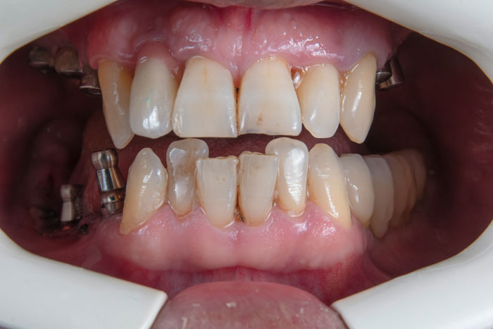 Close-up of a mouth showing natural teeth alongside dental implants, highlighting advances in tooth regrowth technology. Close-up of a mouth showing natural teeth alongside dental implants, highlighting advances in tooth regrowth technology.