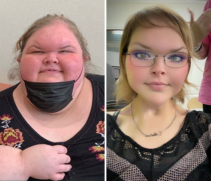 Before and after photos of 1000-Lb Sisters’ Tammy Slaton showing dramatic skin removal surgery results and transformation. Before and after photos of 1000-Lb Sisters’ Tammy Slaton showing dramatic skin removal surgery results and transformation.