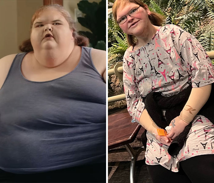 Tammy Slaton from 1000-Lb Sisters shows transformation after skin removal surgery, looking barely recognizable in before and after photos. Tammy Slaton from 1000-Lb Sisters shows transformation after skin removal surgery, looking barely recognizable in before and after photos.