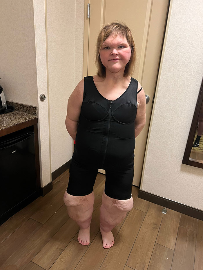 Tammy Slaton from 1000-Lb Sisters shows results of skin removal surgery wearing black compression garment indoors. Tammy Slaton from 1000-Lb Sisters shows results of skin removal surgery wearing black compression garment indoors.