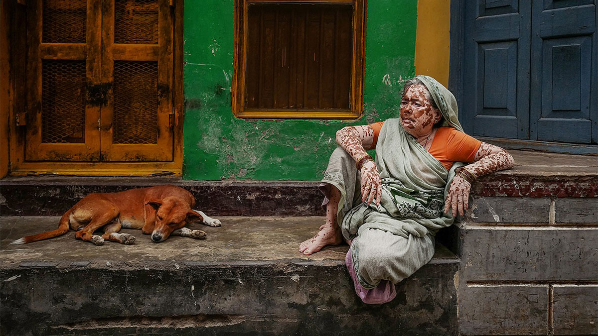 Indian woman with vitiligo sitting on street steps next to a sleeping dog in colorful urban surroundings, street photo.