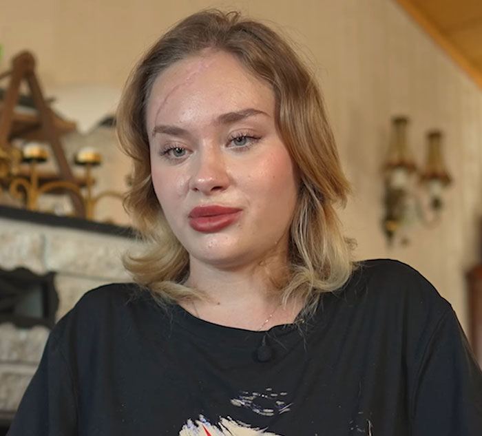 Ukrainian model with visible facial injuries speaking about party before attack, seated indoors in casual black shirt Ukrainian model with visible facial injuries speaking about party before attack, seated indoors in casual black shirt