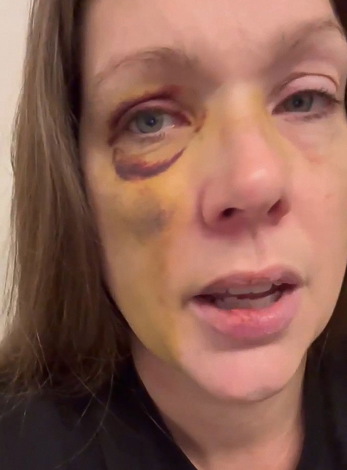 Close-up of a mom with bruised and swollen face after being punched and knocked out in a violent Cincinnati brawl. Close-up of a mom with bruised and swollen face after being punched and knocked out in a violent Cincinnati brawl.