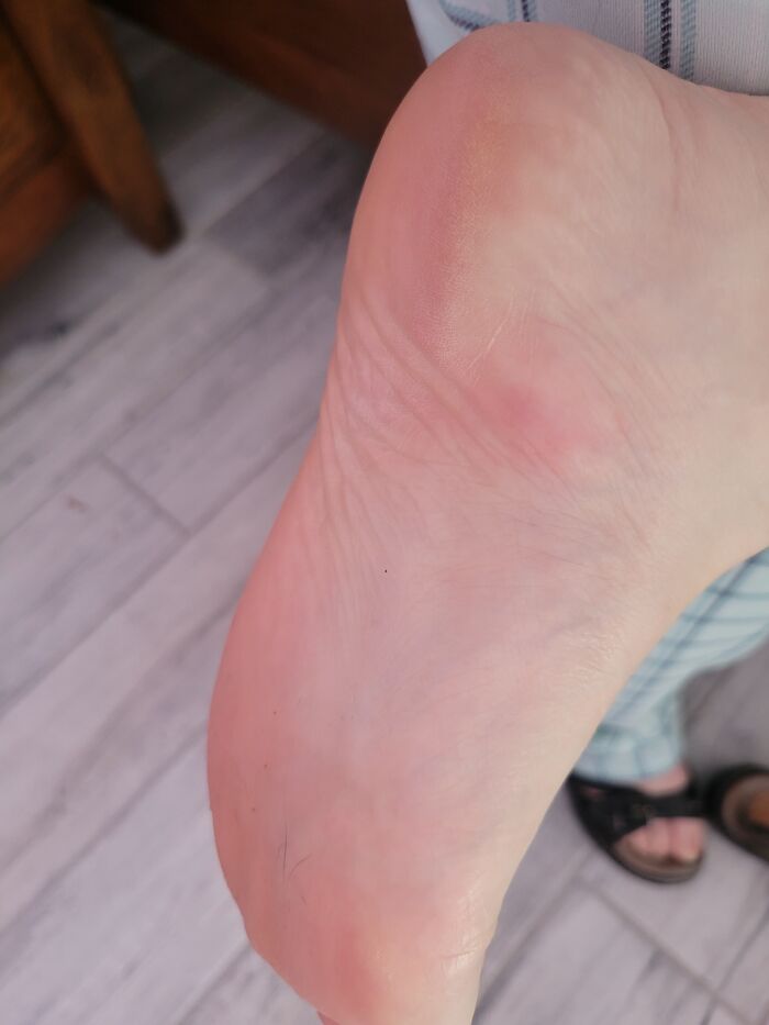 Mosquito Bite - Gotta Love How The One Mosquito In Las Vegas Found The Bottom Of My Foot