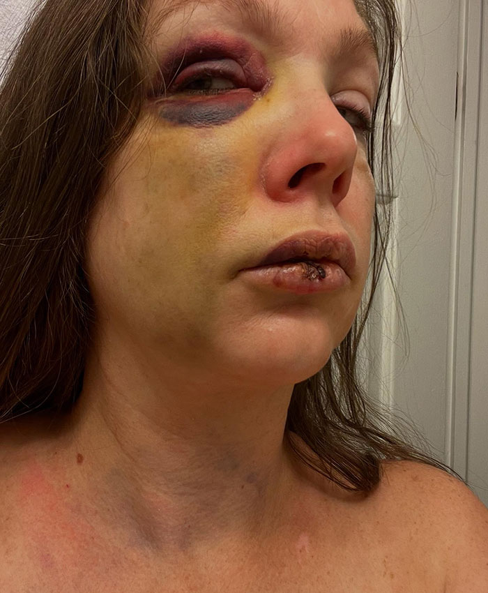 Close-up of a mom with severe bruising and a swollen lip after violent Cincinnati brawl injury. Close-up of a mom with severe bruising and a swollen lip after violent Cincinnati brawl injury.