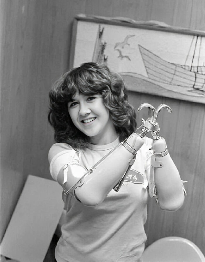 Young woman with double hooks prosthetic arms smiling in a black and white historical photo from the 1970s era.