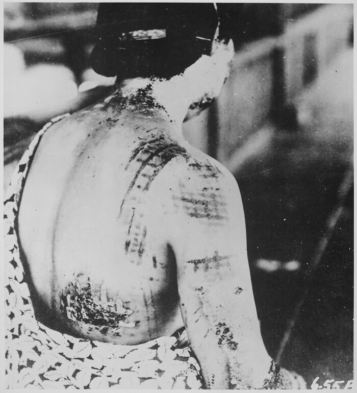 Black and white historical photo showing a person with visible scars on their back and arm, highlighting historical photos and backstories.