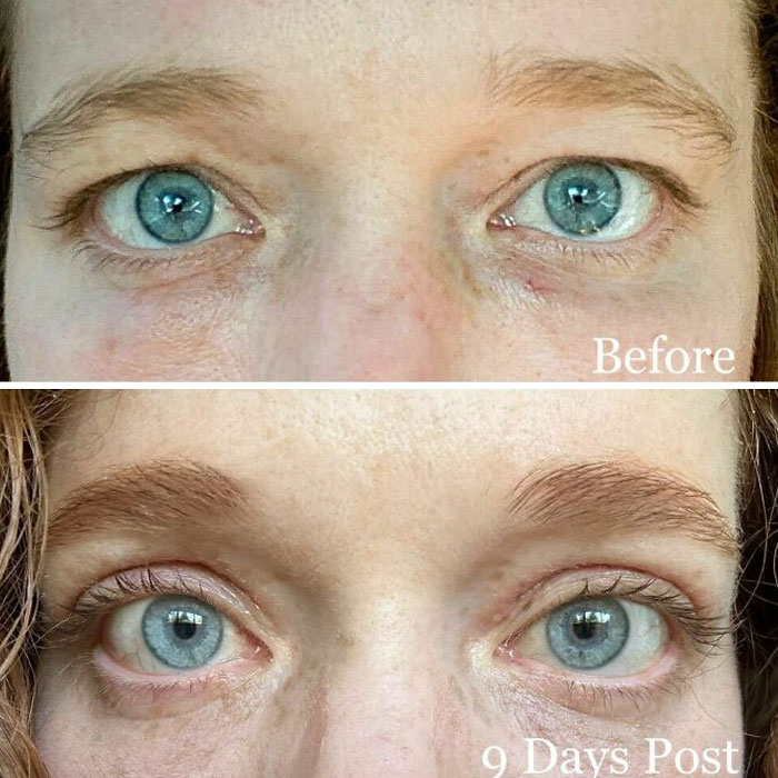 Close-up before and after plastic surgery images showing eye area transformation nine days post procedure.