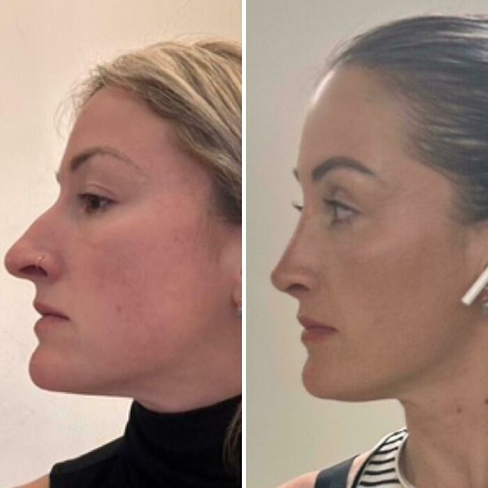 Side-by-side before and after plastic surgery profile photos showing dramatic facial transformation and enhancement results.