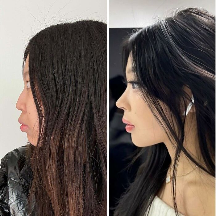 Before and after plastic surgery side profile of a woman showing cosmetic transformation and enhancement.