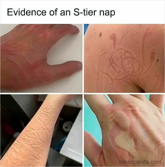 Close-up images showing impressions on skin from objects after an S-tier nap, illustrating relatable memes about funny moments.