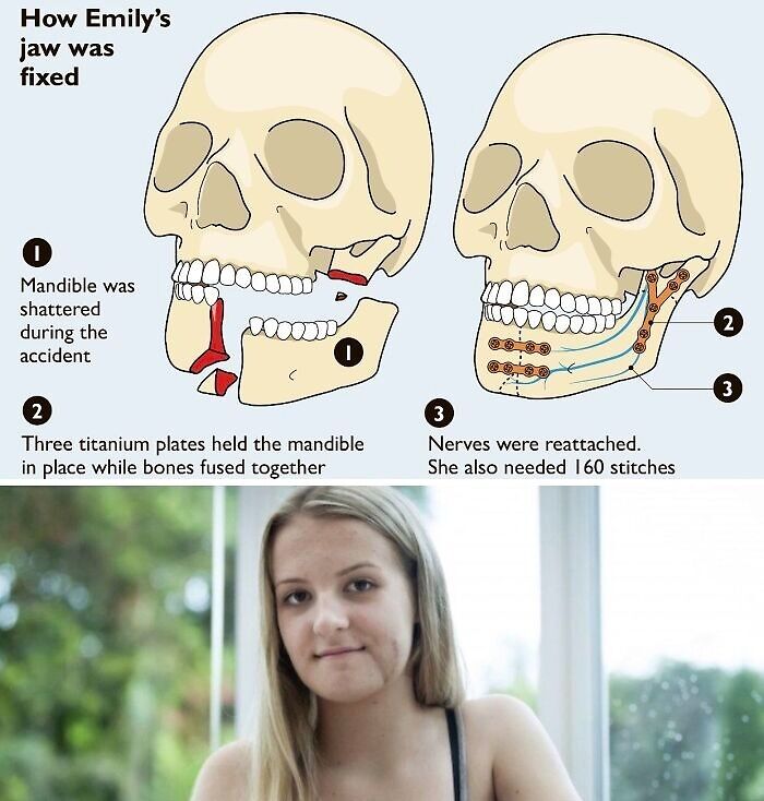Diagram showing how Emily’s shattered jaw was fixed with titanium plates and reattached nerves, unsettling medical image from Morbid Knowledge group.