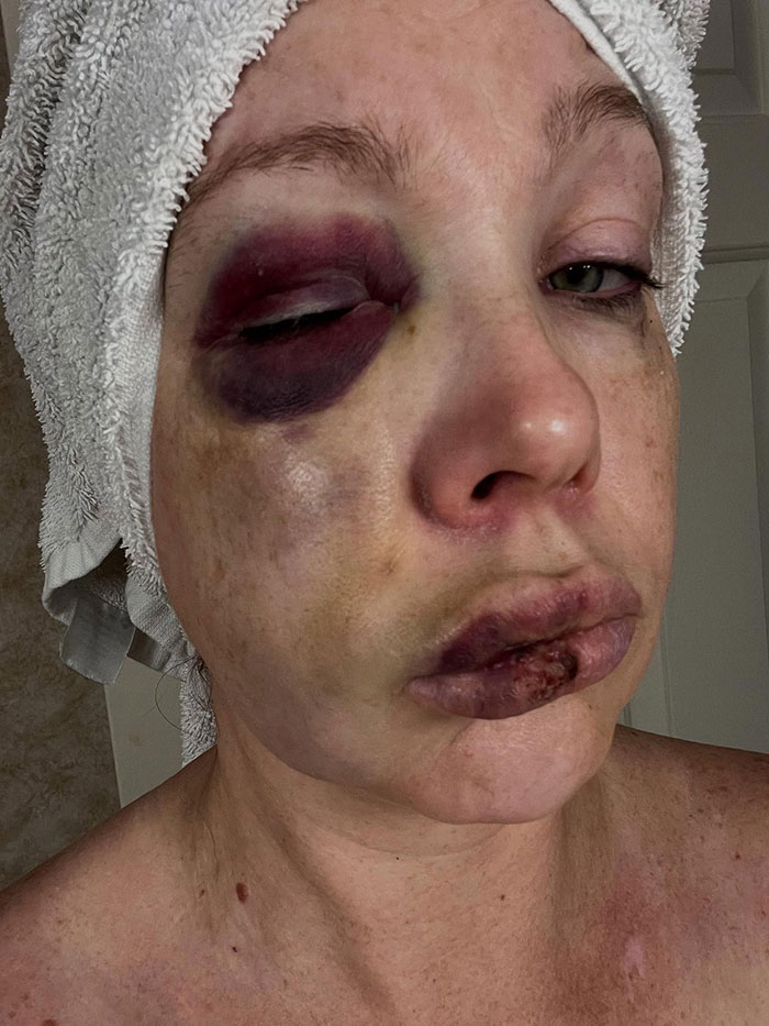 Close-up of mom with a black eye and bruised lips after violent Cincinnati brawl, showing injuries sustained during the fight. Close-up of mom with a black eye and bruised lips after violent Cincinnati brawl, showing injuries sustained during the fight.