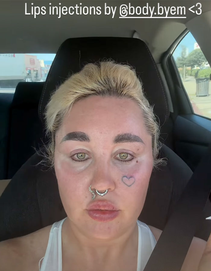 "Love The Lips": Amanda Bynes Shocks Fans With Transformation After Revealing New Cosmetic Procedures "Love The Lips": Amanda Bynes Shocks Fans With Transformation After Revealing New Cosmetic Procedures