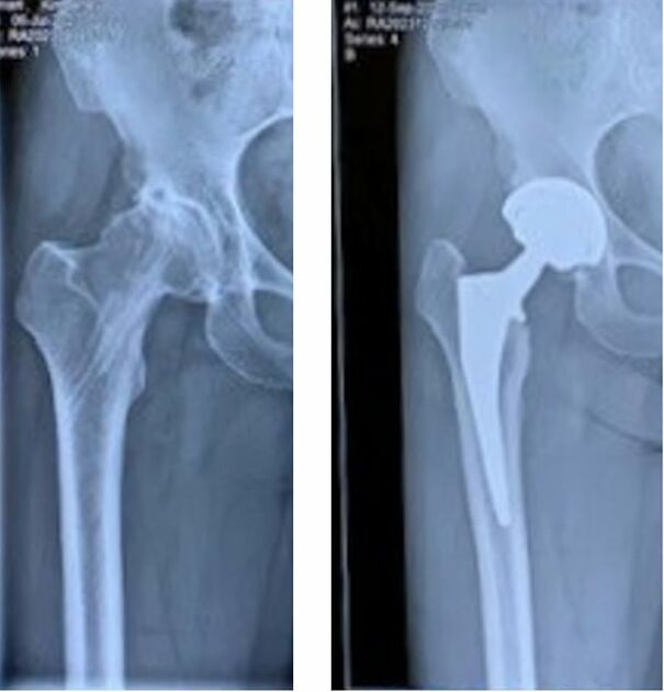Hip-replacement-68af3151d2320.jpg