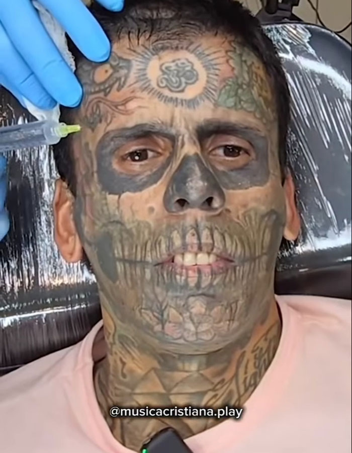 95% tattooed Brazilian Steve-O undergoing a dramatic new look with tattoo removal treatment on his face and neck. 95% tattooed Brazilian Steve-O undergoing a dramatic new look with tattoo removal treatment on his face and neck.