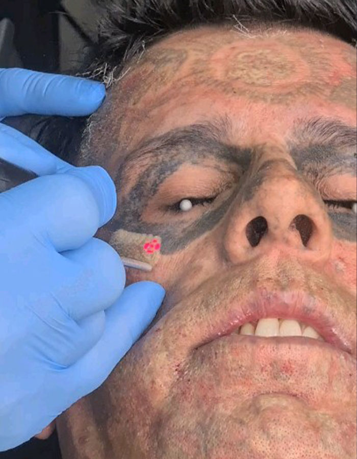 Close-up of Brazilian Steve-O 95% tattooed man undergoing tattoo removal on his face, revealing a dramatic new look. Close-up of Brazilian Steve-O 95% tattooed man undergoing tattoo removal on his face, revealing a dramatic new look.