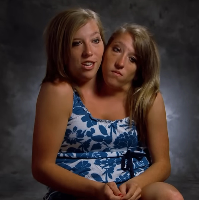 Conjoined Hensel twins sitting together, sparking discussion about motherhood and marriage in their new baby story. Conjoined Hensel twins sitting together, sparking discussion about motherhood and marriage in their new baby story.