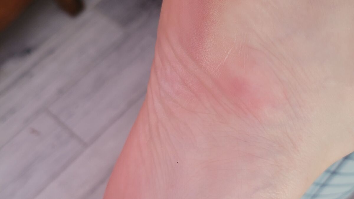 Close-up of an ankle with a red insect bite showing irritation and swelling after a bug or insect bite.