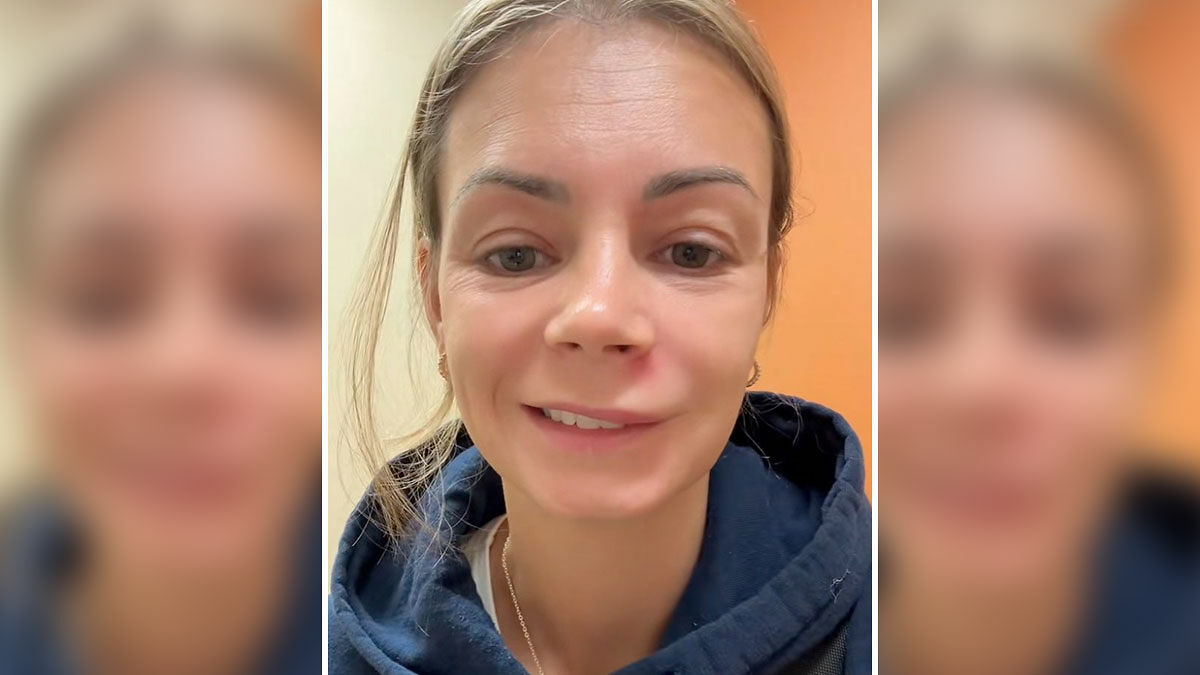 Woman in urgent care with facial swelling after popping pimple in the dangerous triangle of death area on her face