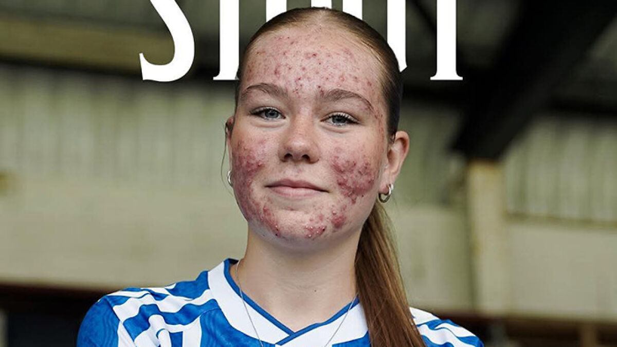 Young female soccer player with acne, wearing a blue and white jersey, posing in a stadium setting after new signing announcement.
