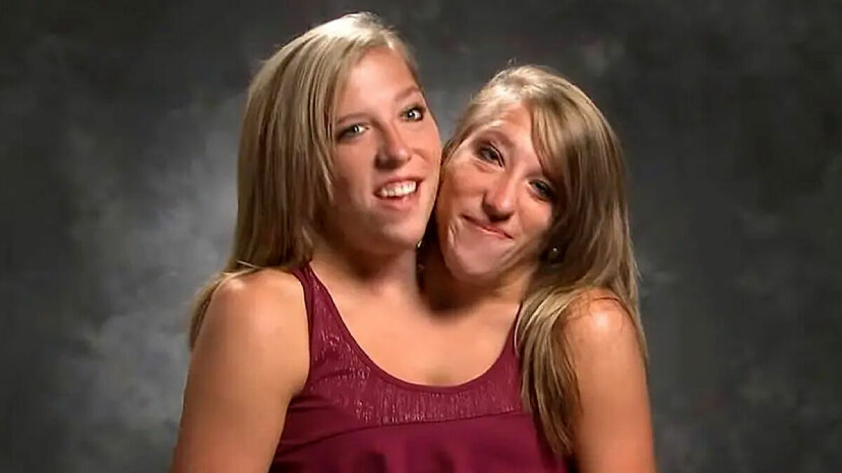 Conjoined twins Abby and Brittany Hensel smiling together against a dark blurred background.