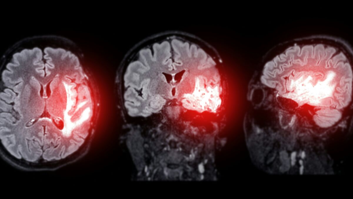 MRI brain scans showing highlighted areas of stroke risk related to post-exercise habits from a neurologist's warning.