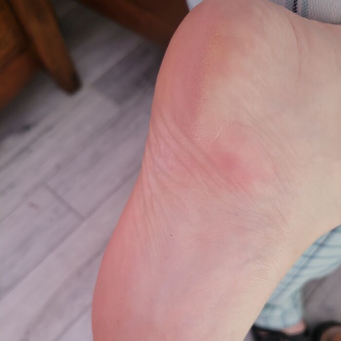 Hey Pandas, What Was The Worst Place You’ve Gotten Bitten By A Bug Or Insect