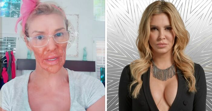 Brandi Glanville Reveals New Smile After $130K Health Battle And Face-Disfiguring Parasite
