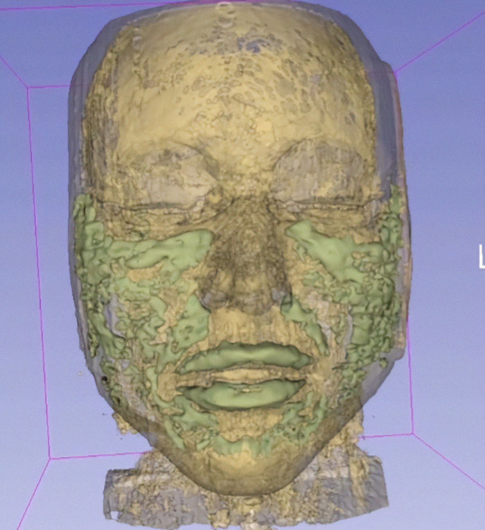 3D scan of a face showing uneven textures, related to Love Island face trend and filler blindness concerns. 3D scan of a face showing uneven textures, related to Love Island face trend and filler blindness concerns.