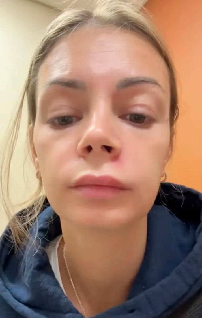 Mom Ends Up in Urgent Care After Popping Pimple In The “Triangle Of Death” Mom Ends Up in Urgent Care After Popping Pimple In The “Triangle Of Death”