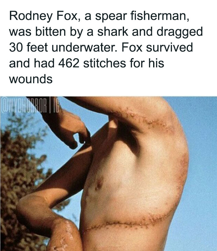 Scarred torso of Rodney Fox, a spear fisherman, who survived a shark attack with 462 stitches in this creepy fact image.