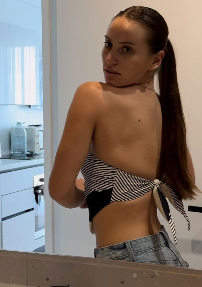 Young woman with long hair in a striped top showing her back, relating to influencer fractures her spine accident news. Young woman with long hair in a striped top showing her back, relating to influencer fractures her spine accident news.