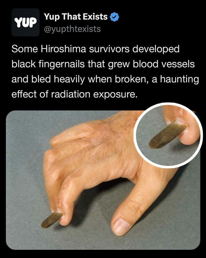 Hand with dark black fingernail, an unusual and real radiation effect from Hiroshima survivors, featured in weird things collection.