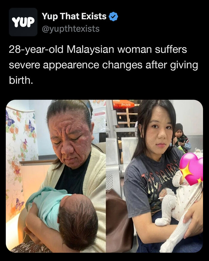 Split image showing severe appearance changes in a 28-year-old Malaysian woman after giving birth, weird things that sound made up