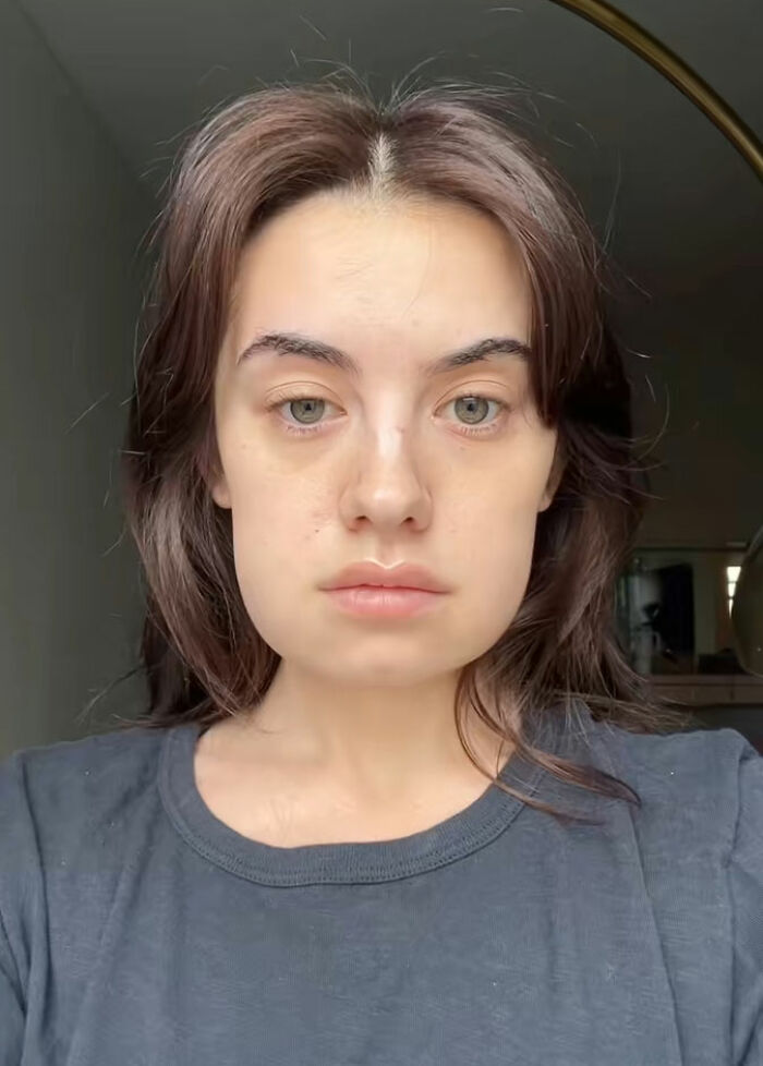 Young woman showing clear skin and natural look after Kybella face treatment during her recovery phase at home.