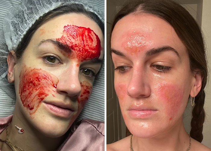 Woman with severe facial injuries from celebrity facialist treatment showing red, damaged skin before and after healing. Woman with severe facial injuries from celebrity facialist treatment showing red, damaged skin before and after healing.