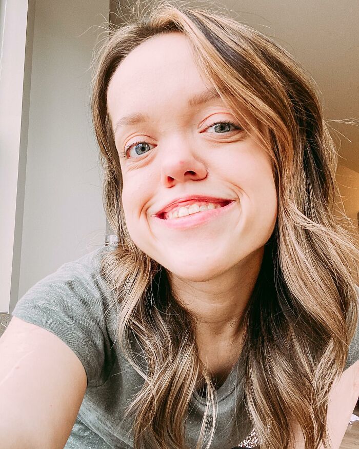 31YO woman with dwarfism smiling, showing transformation after height surgery as a teen in a casual setting. 31YO woman with dwarfism smiling, showing transformation after height surgery as a teen in a casual setting.