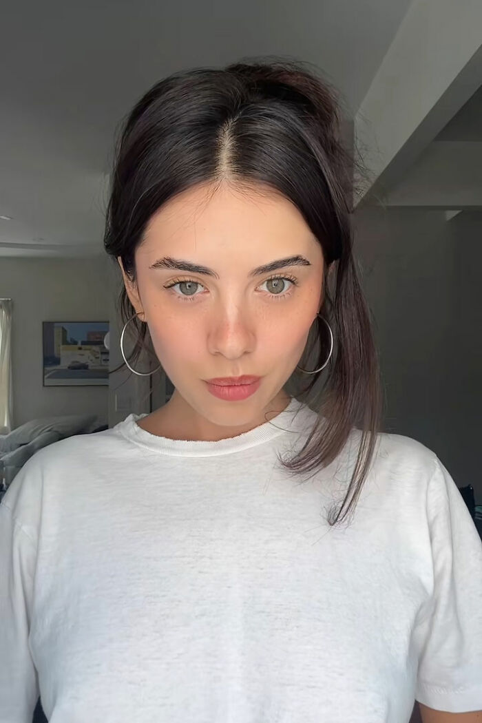 Young woman with hoop earrings and natural makeup showcasing her Kybella face transformation after recovery. Young woman with hoop earrings and natural makeup showcasing her Kybella face transformation after recovery.