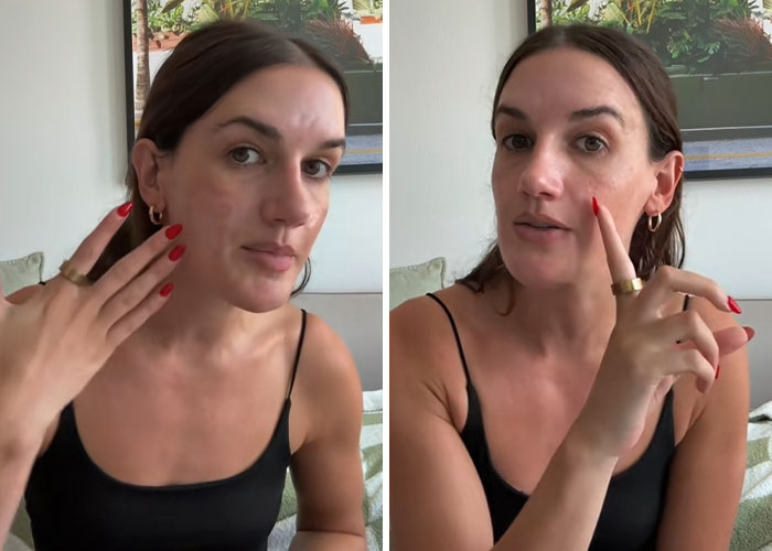 Woman showing facial scars and damage, discussing $90,000 repairs after celebrity facialist caused permanent disfigurement. Woman showing facial scars and damage, discussing $90,000 repairs after celebrity facialist caused permanent disfigurement.