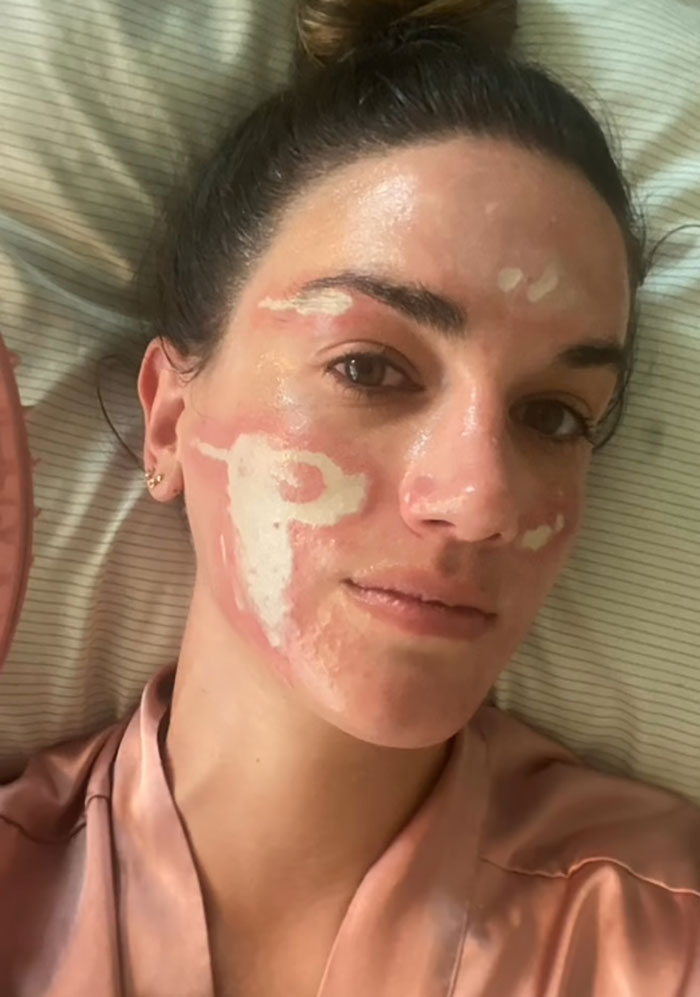 Woman with facial burns and discoloration, showing damage after celebrity facialist treatment and costly $90,000 repairs. Woman with facial burns and discoloration, showing damage after celebrity facialist treatment and costly $90,000 repairs.