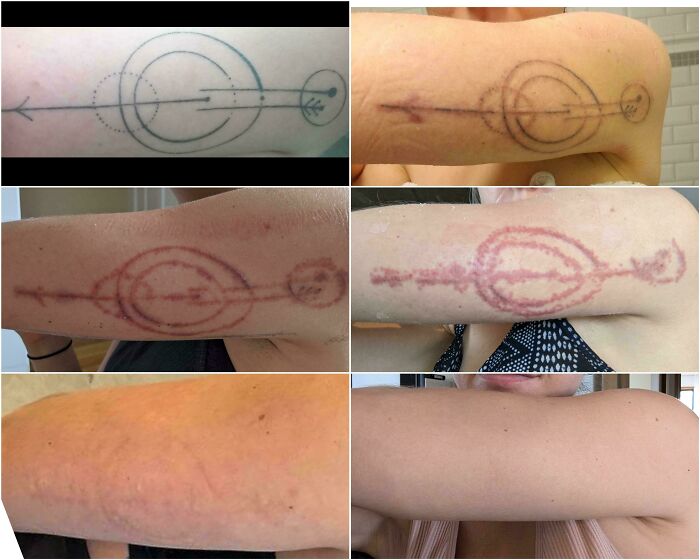 Before and after photos showing tattoo mistakes fading and skin healing over time on a person's arm.
