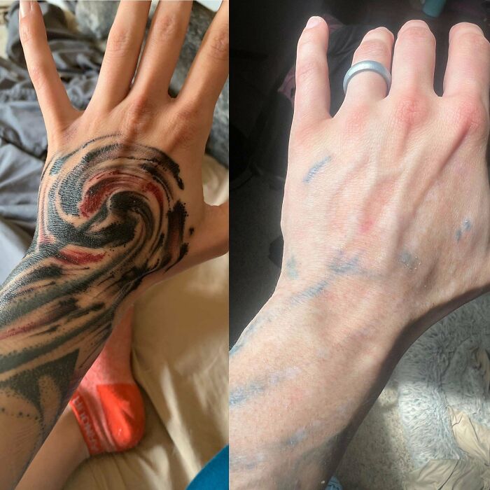 Before and after photos showing tattoo mistakes fading on a hand, demonstrating tattoo removal progress.