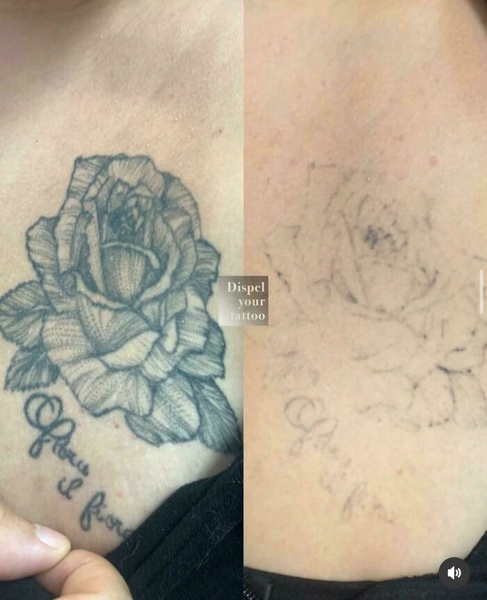 Before and after photos showing tattoo mistakes fading with advanced tattoo removal techniques on skin.