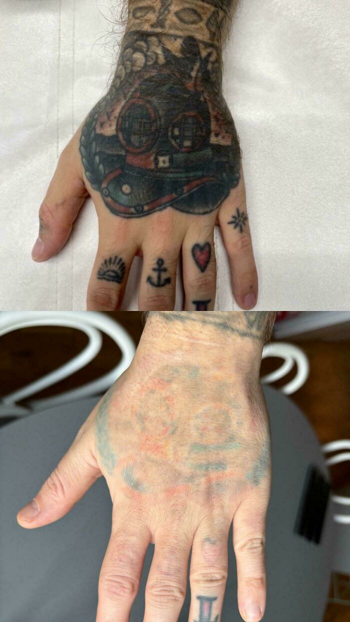 Before and after photos showing tattoo removal progress on a hand with multiple small and a large detailed tattoo.