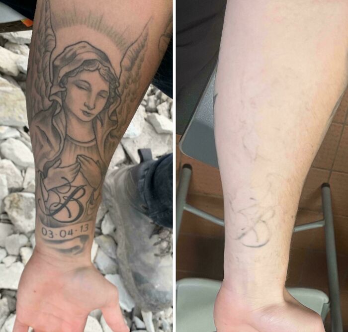 Before and after photos showing successful tattoo removal treatment on a forearm with fading ink.