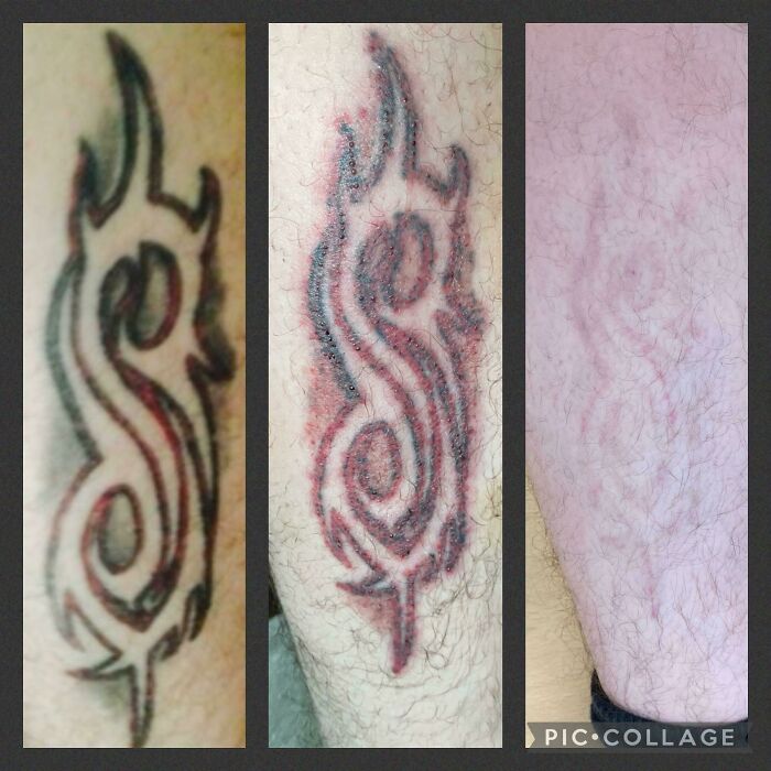 Before and after photos showing tattoo mistakes fading through removal treatments on a person's leg skin.