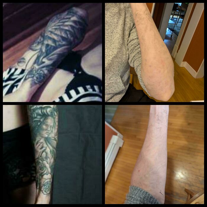 Before and after photos showing tattoo mistakes removed and skin restored on different forearms in indoor settings.